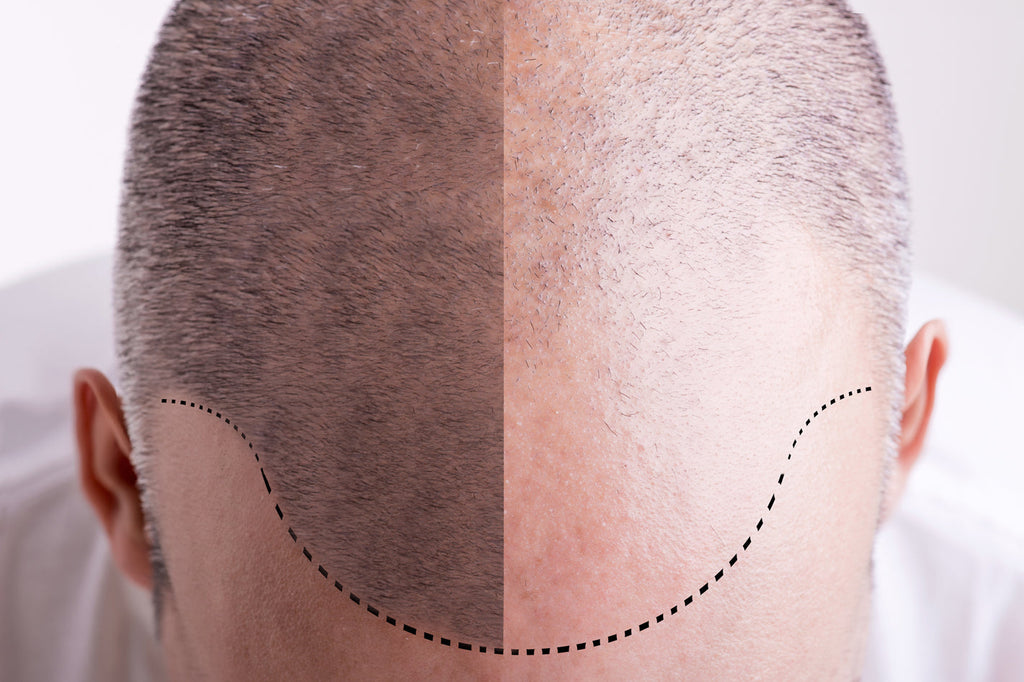 Misslungene Kopfpigmentierung / Kopftätowierung / Trichopigmentation entfernen